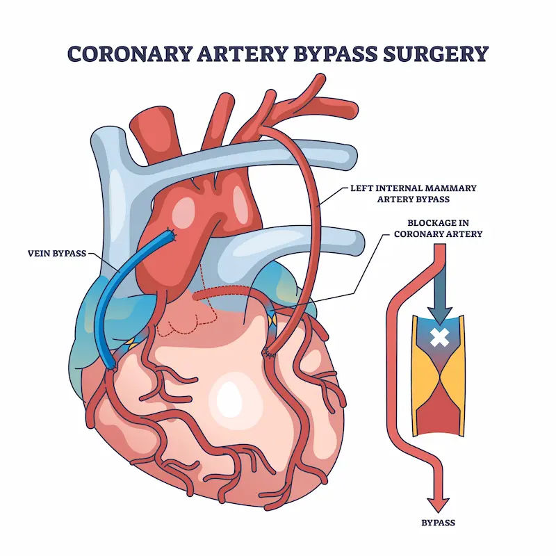 Bypass Surgery A Comprehensive Guide to Treatment and Recovery